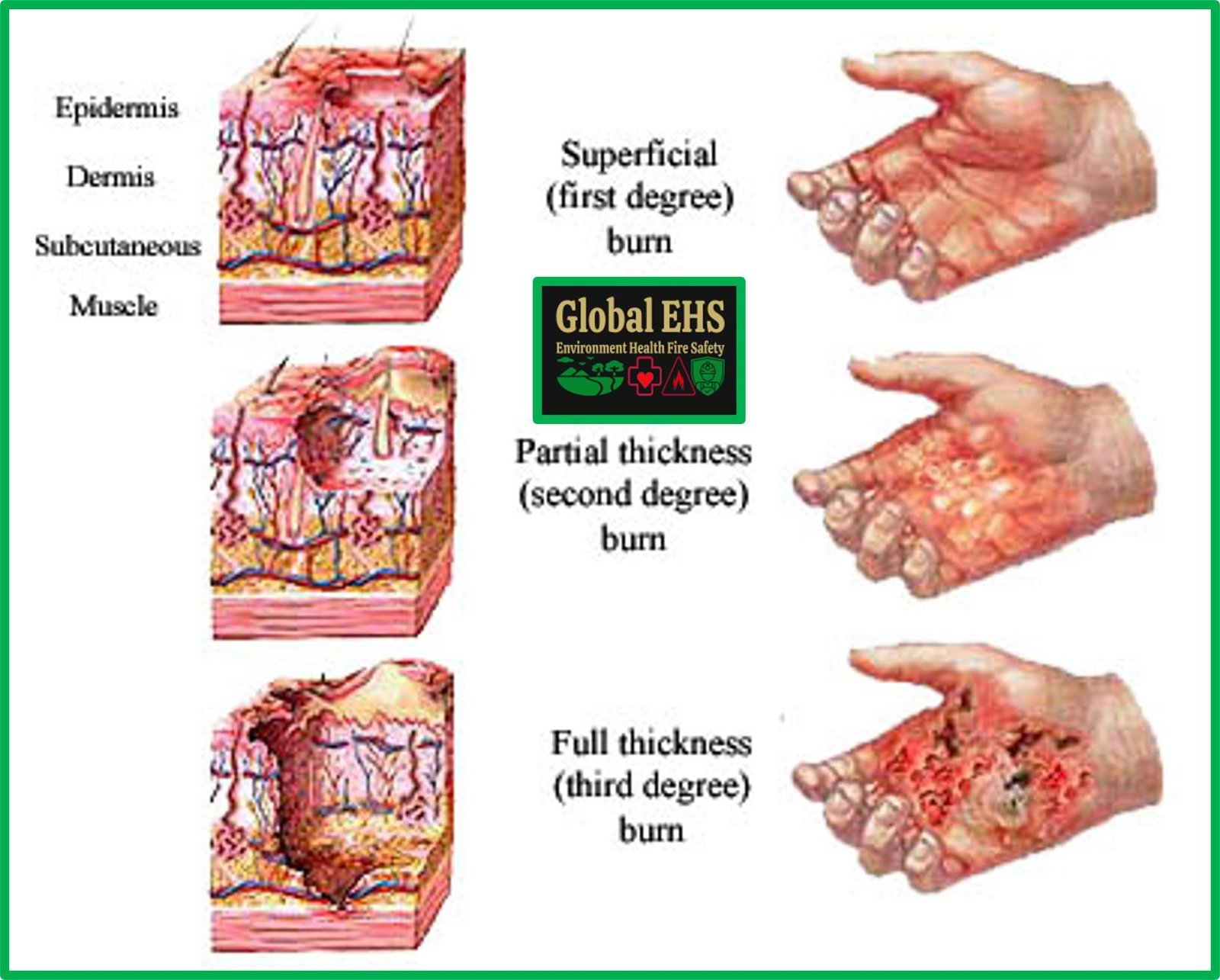 second vs third degree burns