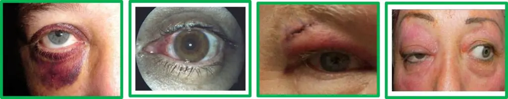 Eye Injury First Aid 