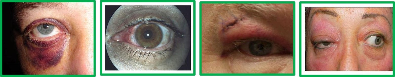 Eye Injury First Aid